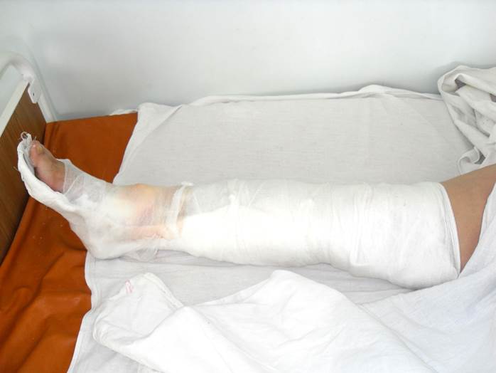 Сломанная нога в гипсе фото мужская