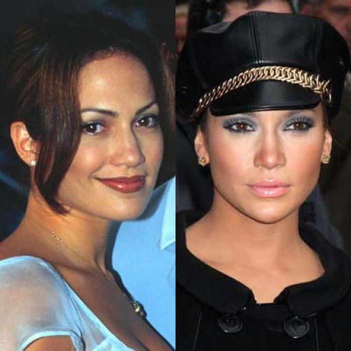 Нос до операции до и после фото